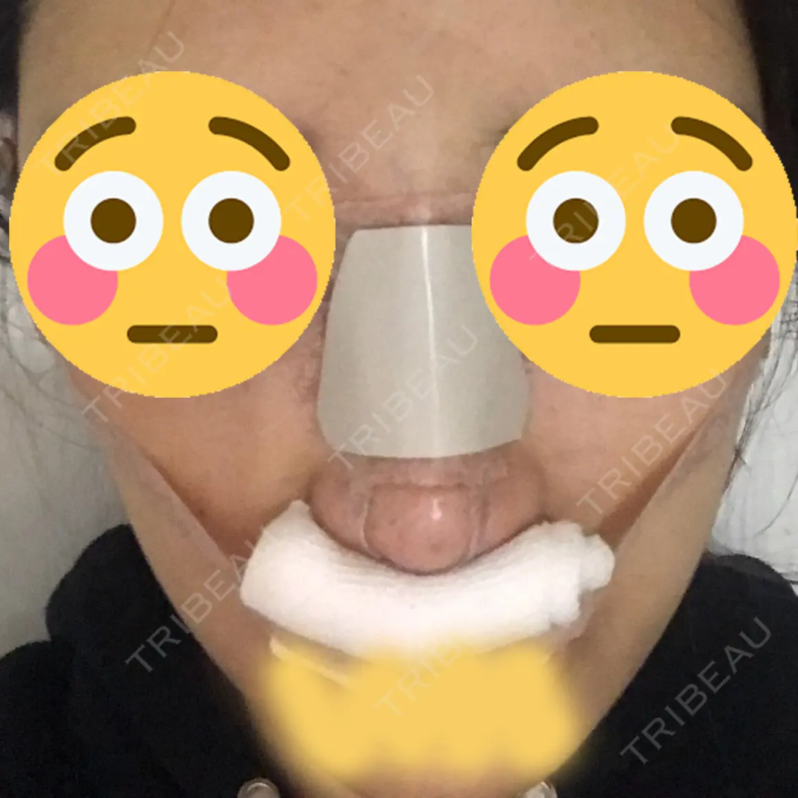 隆鼻術 / 鼻中隔延長（切開） マーブル美容整形外科 DAY 0