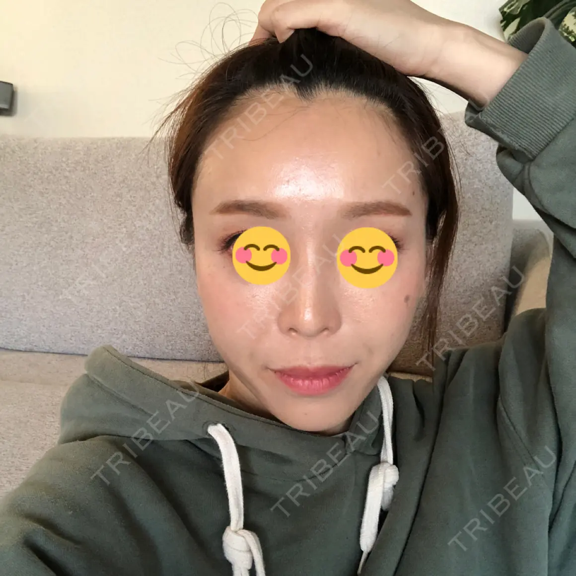 額を丸く / 脂肪注入（肌） / こめかみ形成 / 脂肪注入（額） / 脂肪注入（輪郭） / PRP皮膚再生療法 トップフェイス整形外科 AFTER