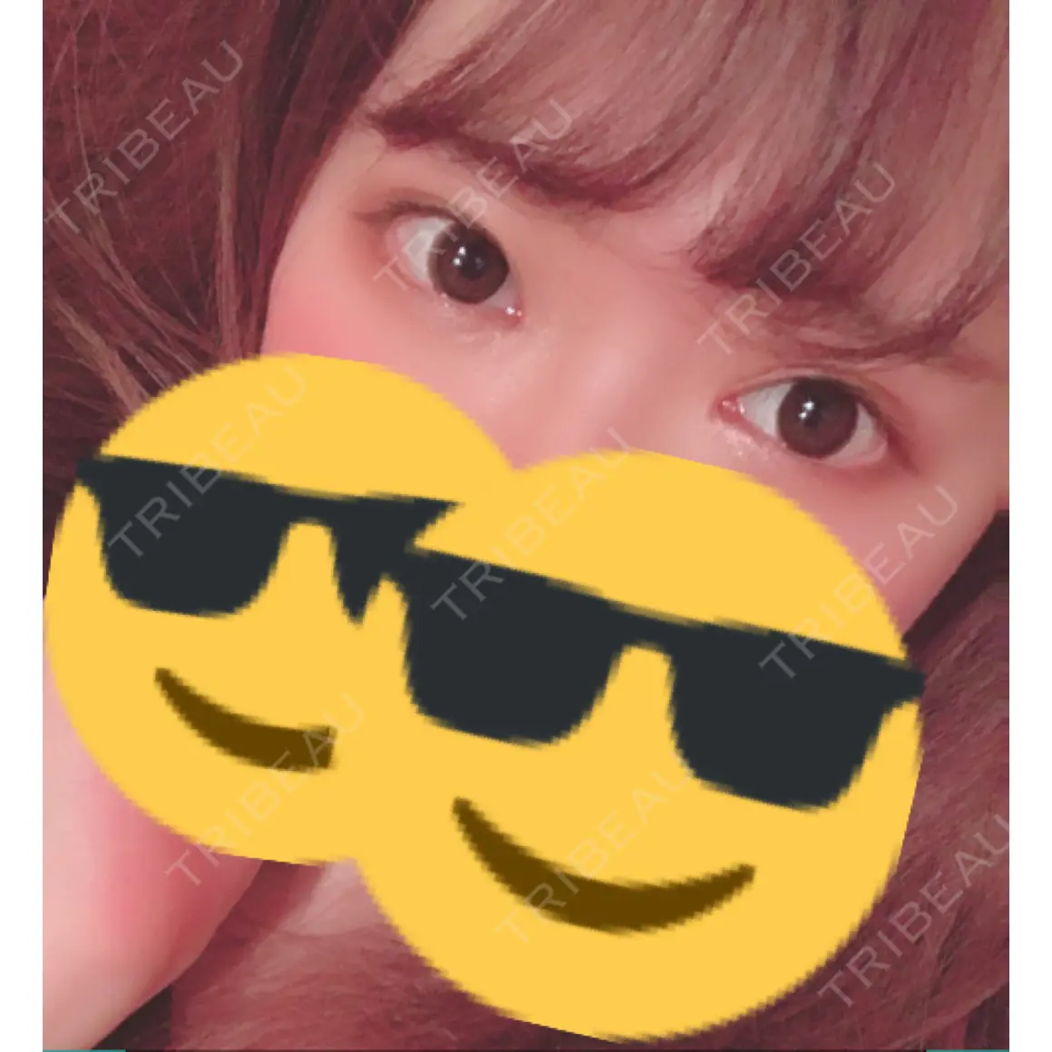 二重切開 / 目頭切開 聖心美容クリニック 札幌院 AFTER