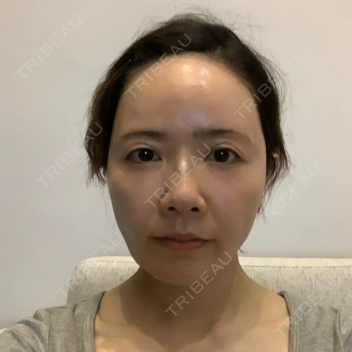 脂肪注入（輪郭） 湘南美容クリニック 札幌院 AFTER