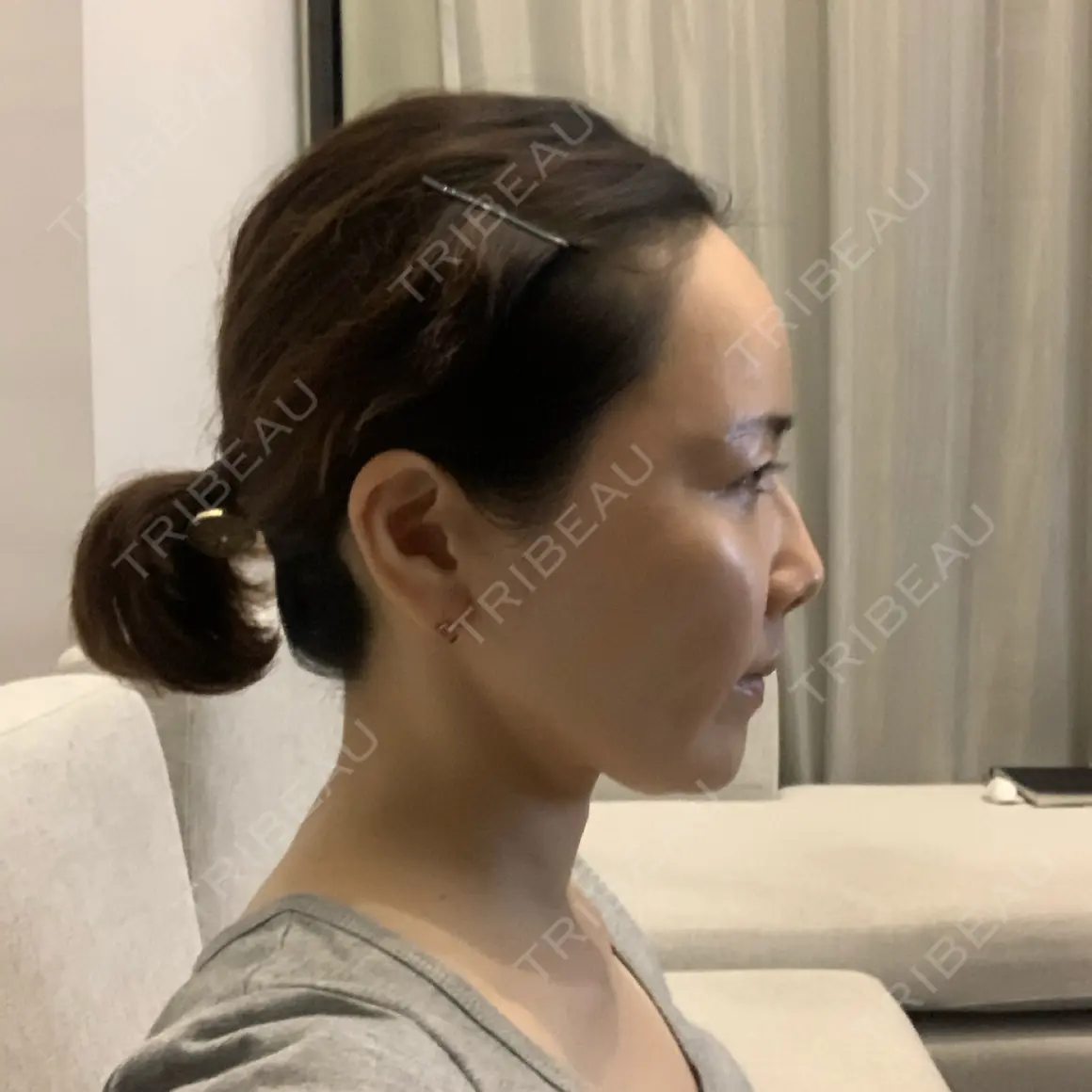 脂肪注入（輪郭） 湘南美容クリニック 札幌院 AFTER