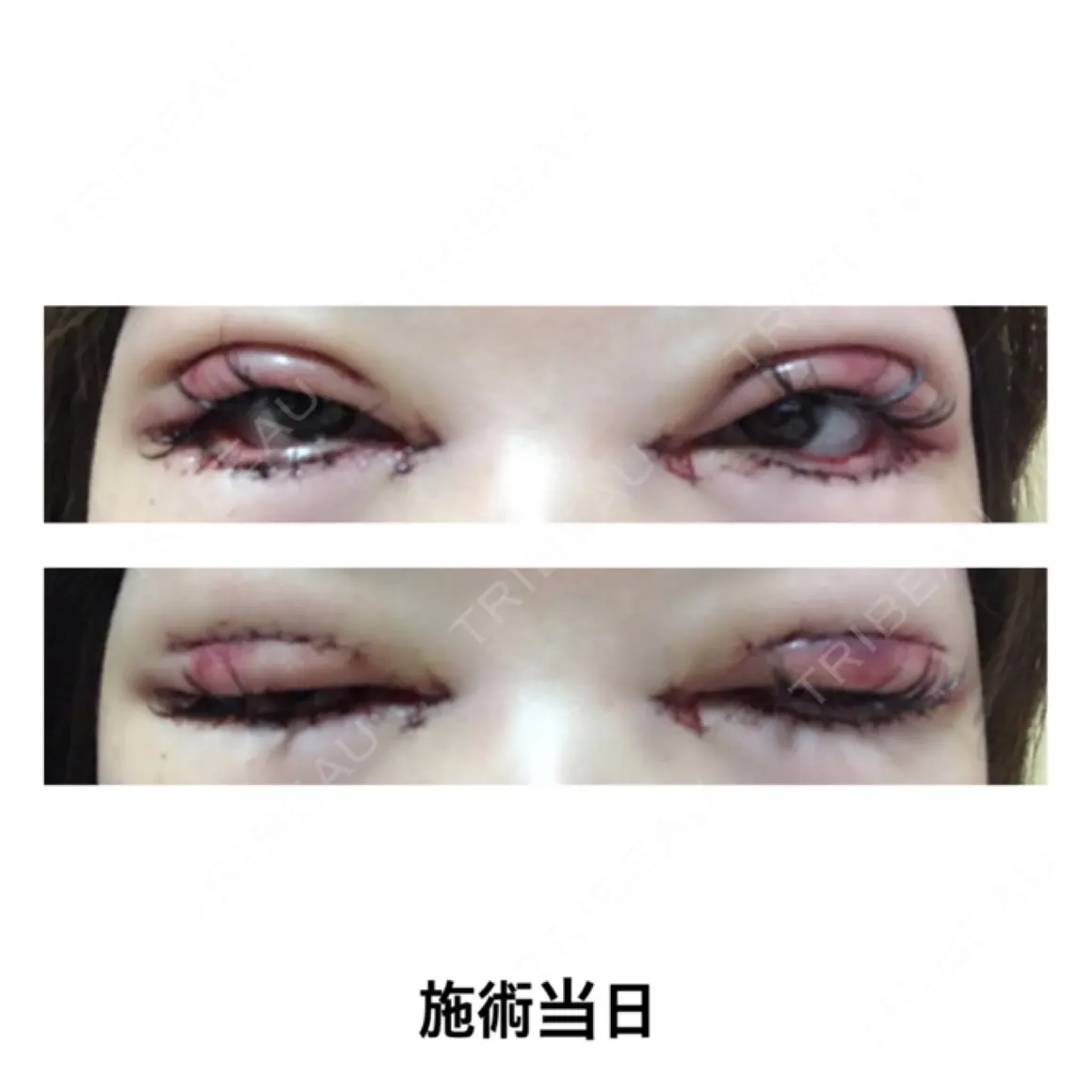 二重切開 / 目頭切開 / 眼瞼下垂（切開） / タレ目形成・グラマラスライン（切開） 大阪TAクリニック DAY 0