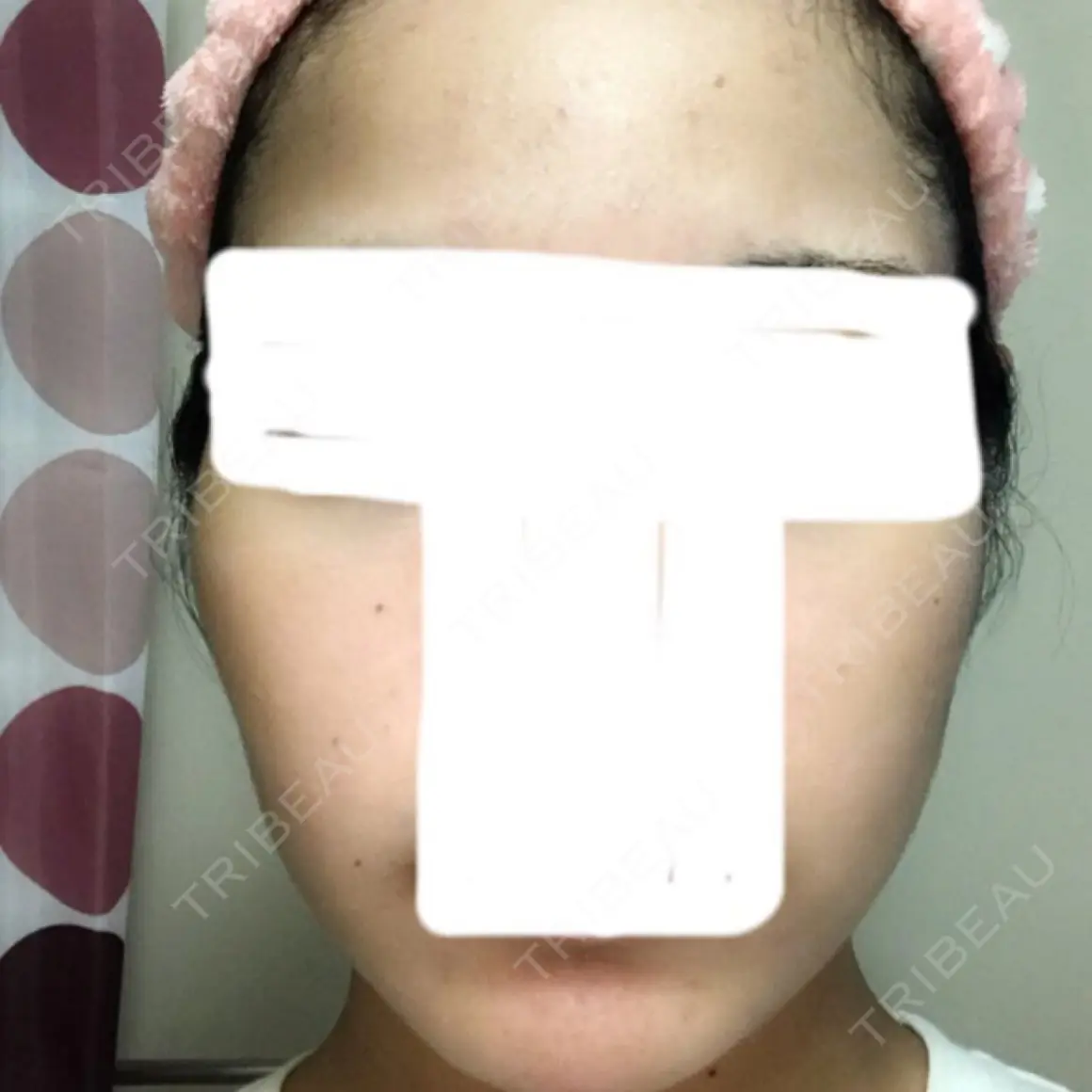 ボトックス（エラ・小顔） / 脂肪溶解注射（顔） / 脂肪溶解注射（二の腕） クリニックA.O. AFTER