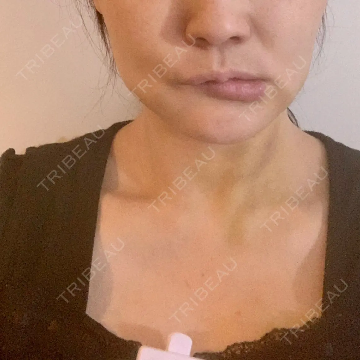 脂肪吸引（顔） / 脂肪吸引（二の腕） / 脂肪吸引（脚） / 豊胸（脂肪注入） / 脂肪注入（輪郭） / その他（ボディ） Mods Clinic（モッズクリニック） 東京院 DAY 0