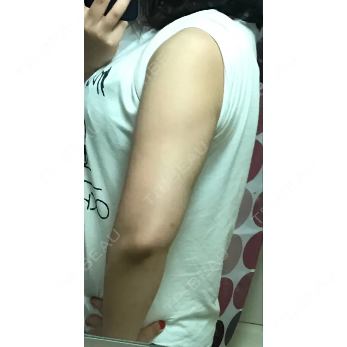 ボトックス（エラ・小顔） / 脂肪溶解注射（顔） / 脂肪溶解注射（二の腕） クリニックA.O. AFTER