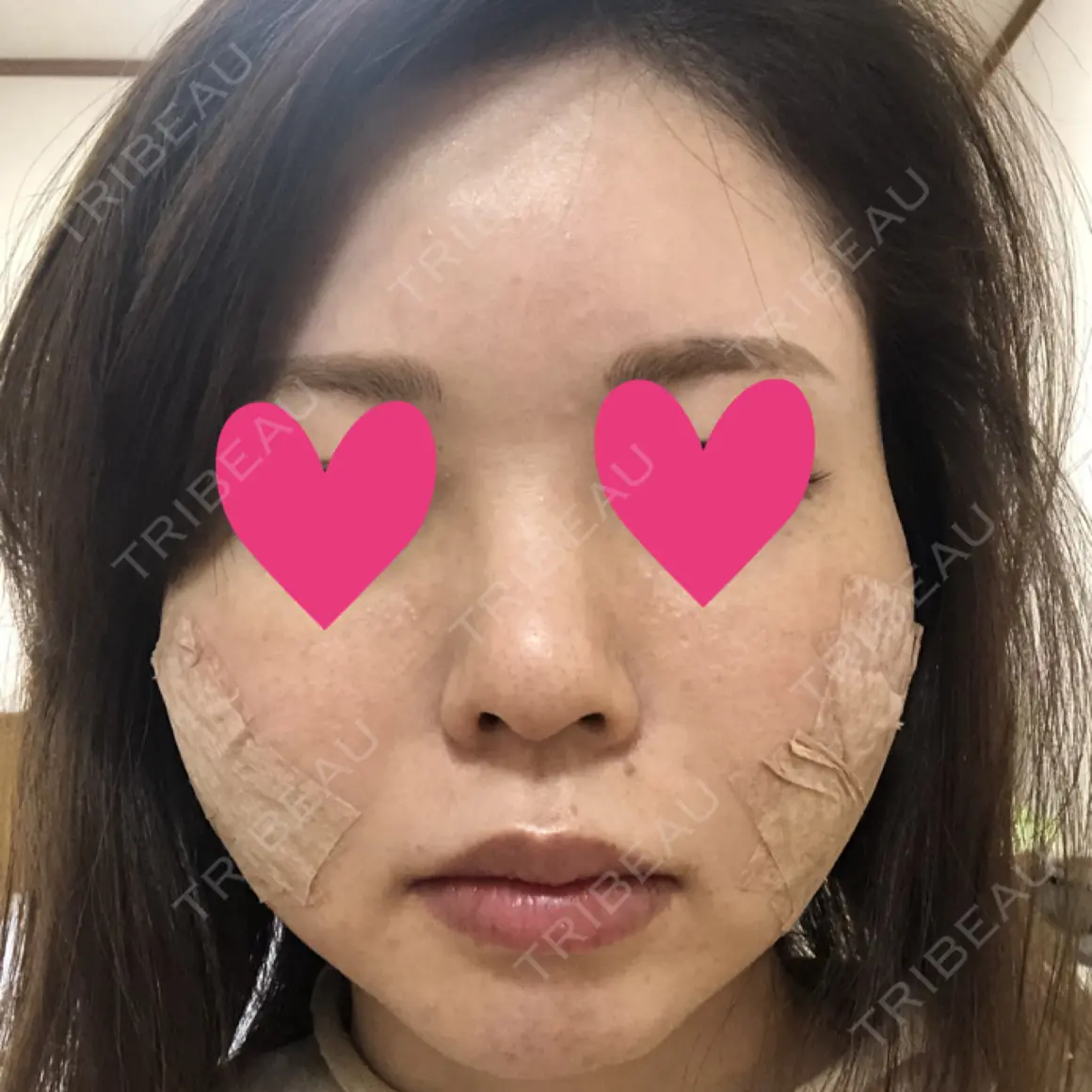 脂肪注入（輪郭） メガクリニック DAY 0