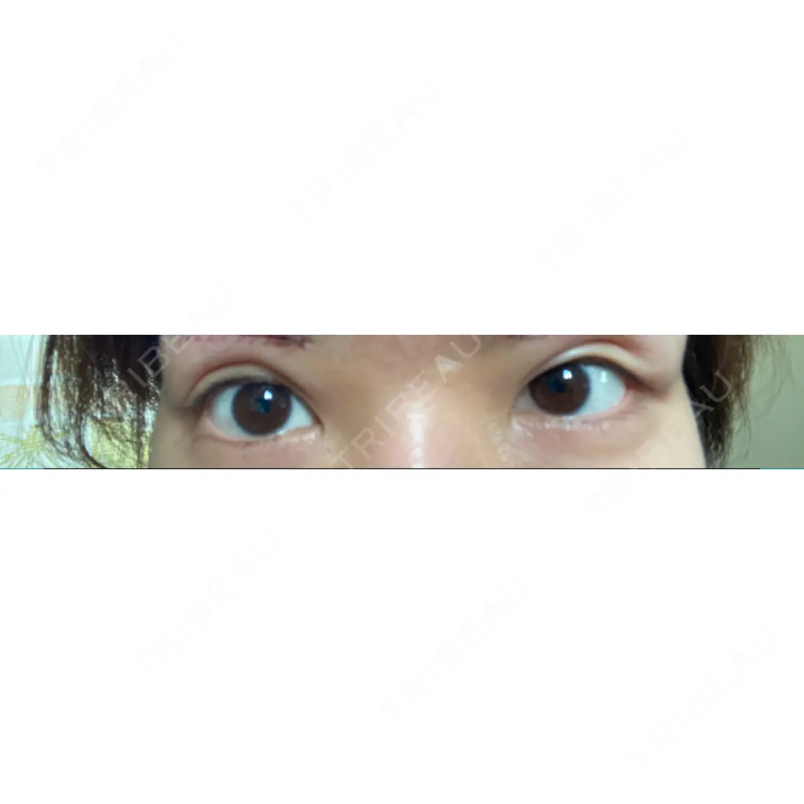 眉下切開 福岡TAクリニック DAY 1