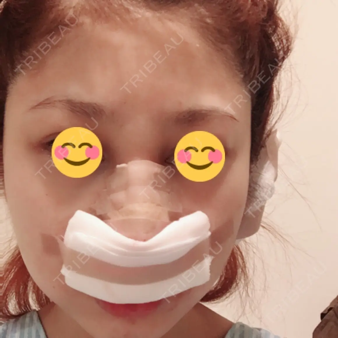鼻尖形成（切開） / 鼻中隔延長（切開） / 骨切幅寄せ / 鼻尖縮小 ヴェリテクリニック 名古屋院 DAY 0