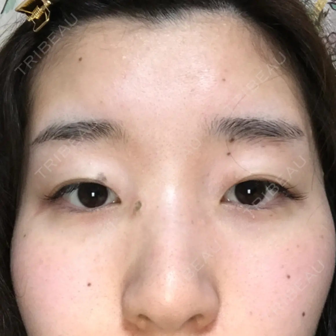 二重埋没 共立美容外科 大宮院 AFTER