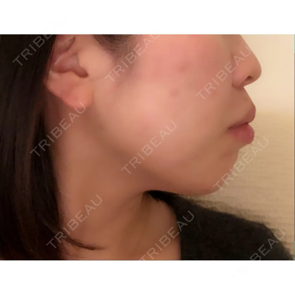 脂肪溶解注射（顔） 東京ロイヤルクリニック AFTER