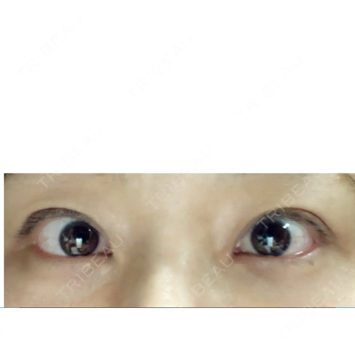 眼瞼下垂（切開） セオリークリニック AFTER