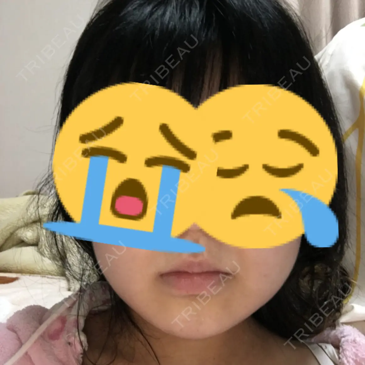 その他（輪郭） 品川美容外科 静岡院 DAY 0