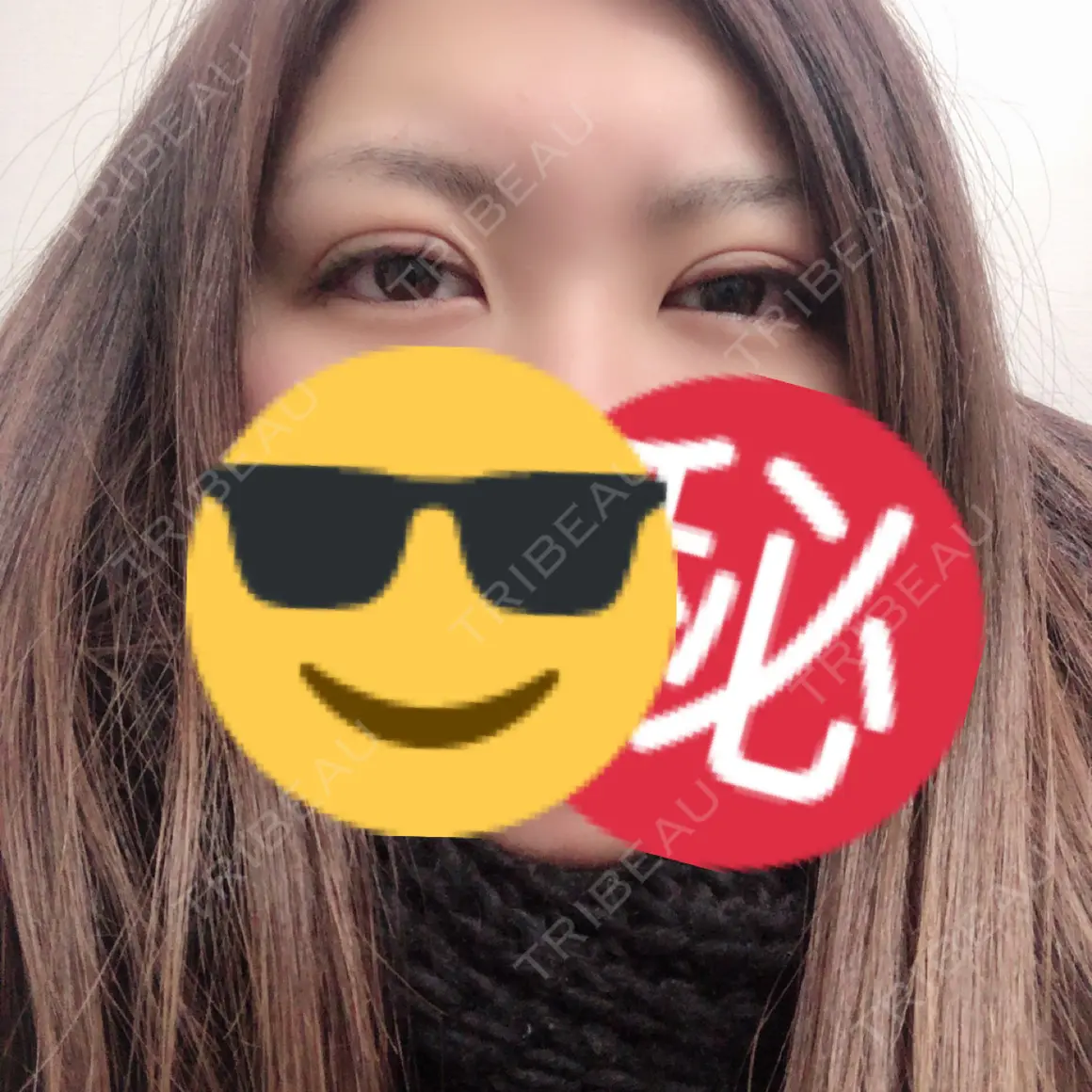 二重埋没 / 上まぶたの脂肪取り TCB東京中央美容外科 郡山院 DAY 0