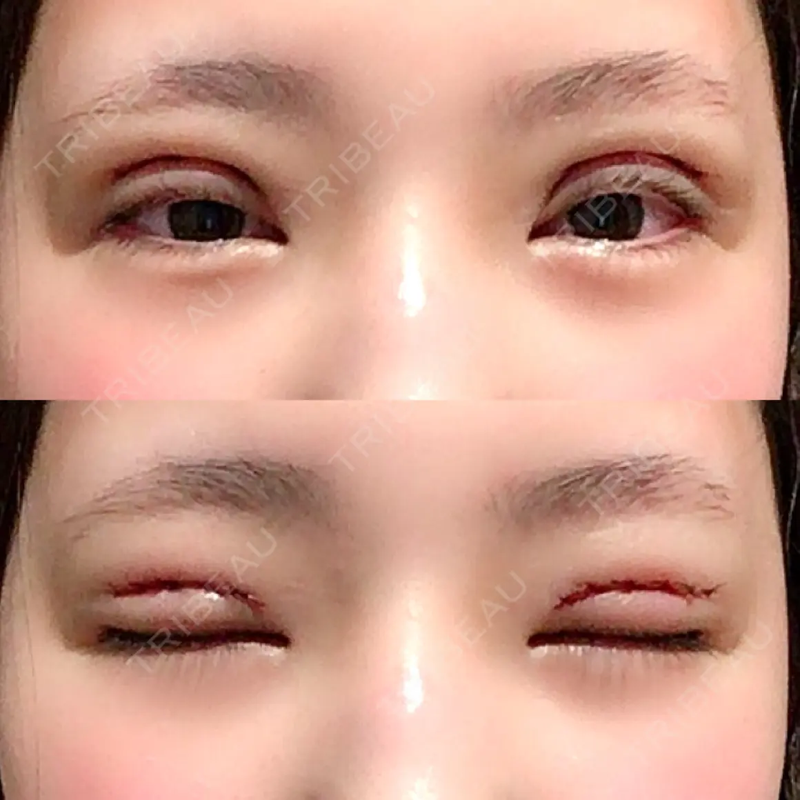二重切開 / 上まぶたたるみ取り 湘南美容クリニック 名古屋栄院 DAY 0