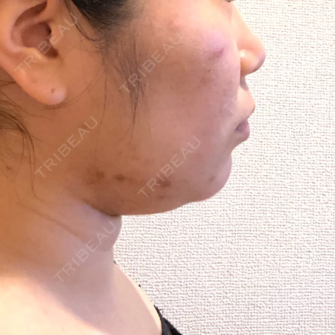 脂肪吸引（顔） アサミ美容外科 名古屋院 AFTER