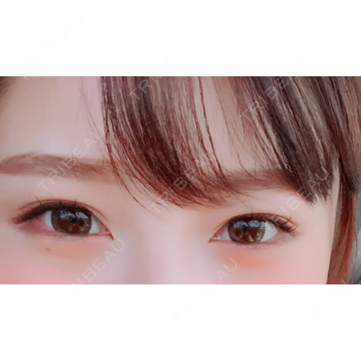 二重埋没 / 上まぶたの脂肪取り 共立美容外科 柏院 AFTER
