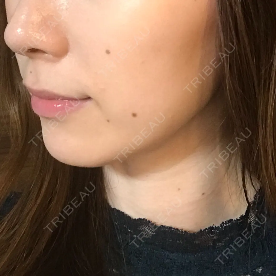 ボトックス（エラ・小顔） 湘南美容クリニック 新宿本院 AFTER