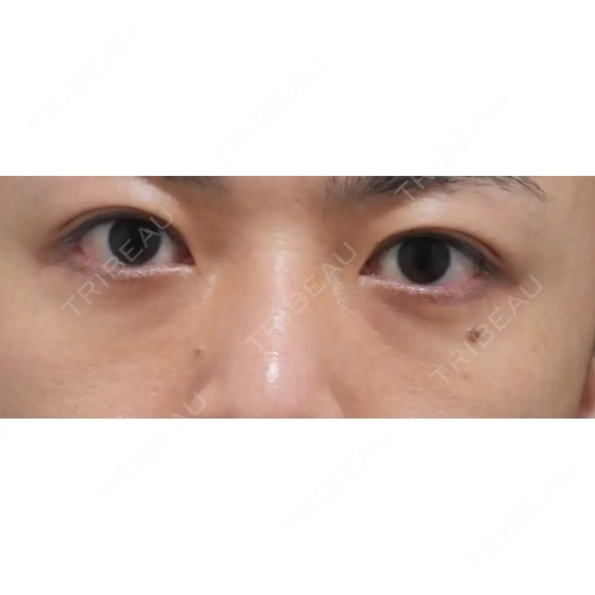 下まぶたたるみ取り 東京イセアクリニック AFTER
