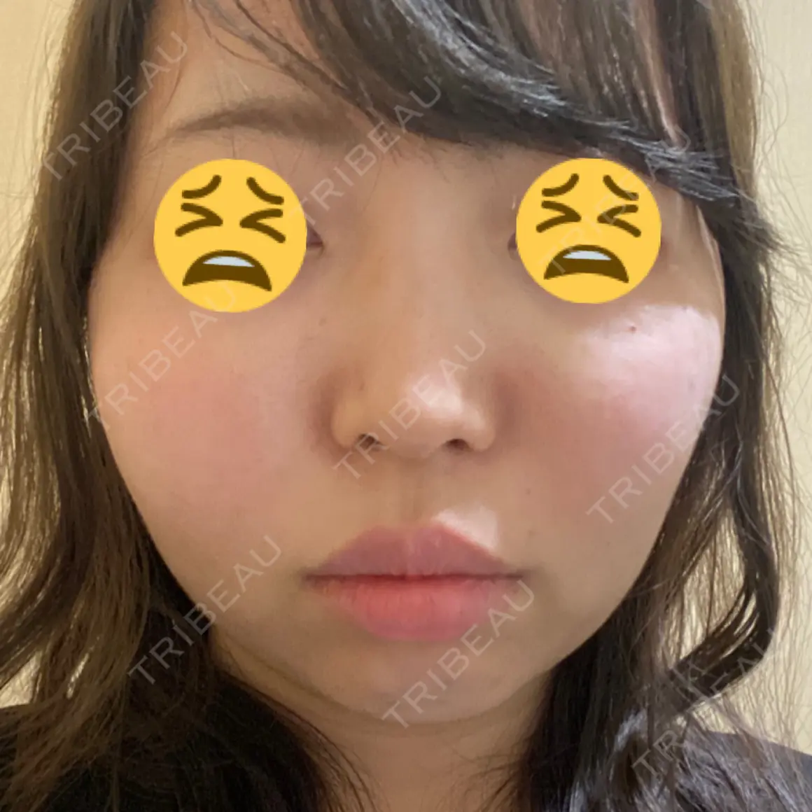 脂肪溶解注射（顔） 品川美容外科 新宿院（※品川スキンクリニック提携） DAY 0