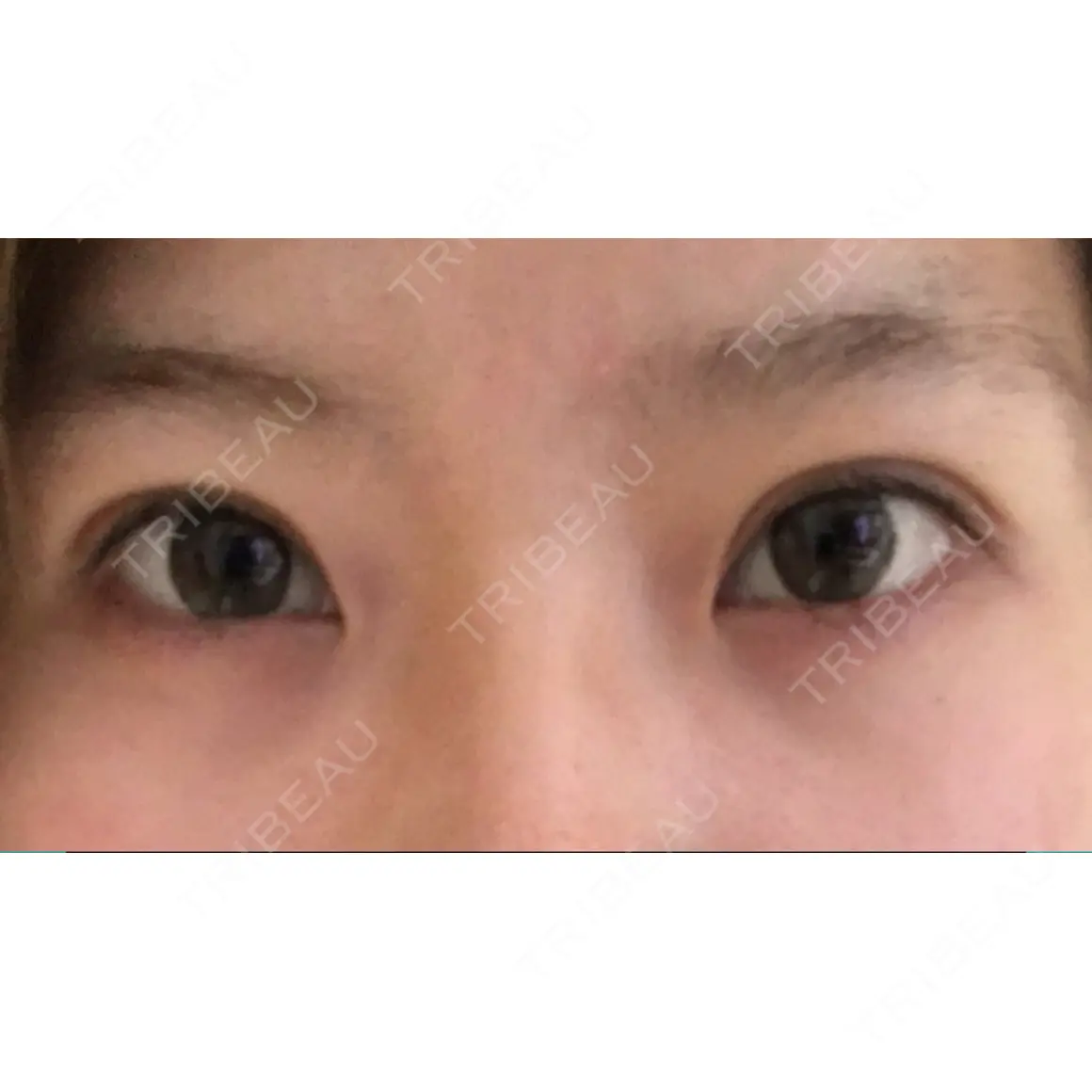 眼瞼下垂（切開） 芦屋美容クリニック 芦屋院 AFTER