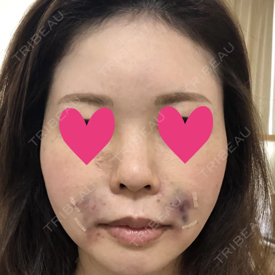 脂肪注入（輪郭） メガクリニック DAY 0