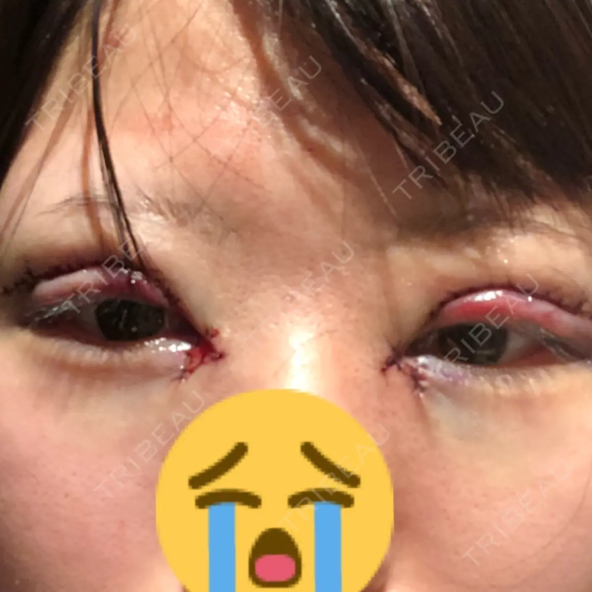 二重切開 / 目頭切開 / 眼瞼下垂（切開） / 上まぶたたるみ取り / 上まぶたの脂肪取り 恵聖会クリニック 心斎橋院 DAY 0