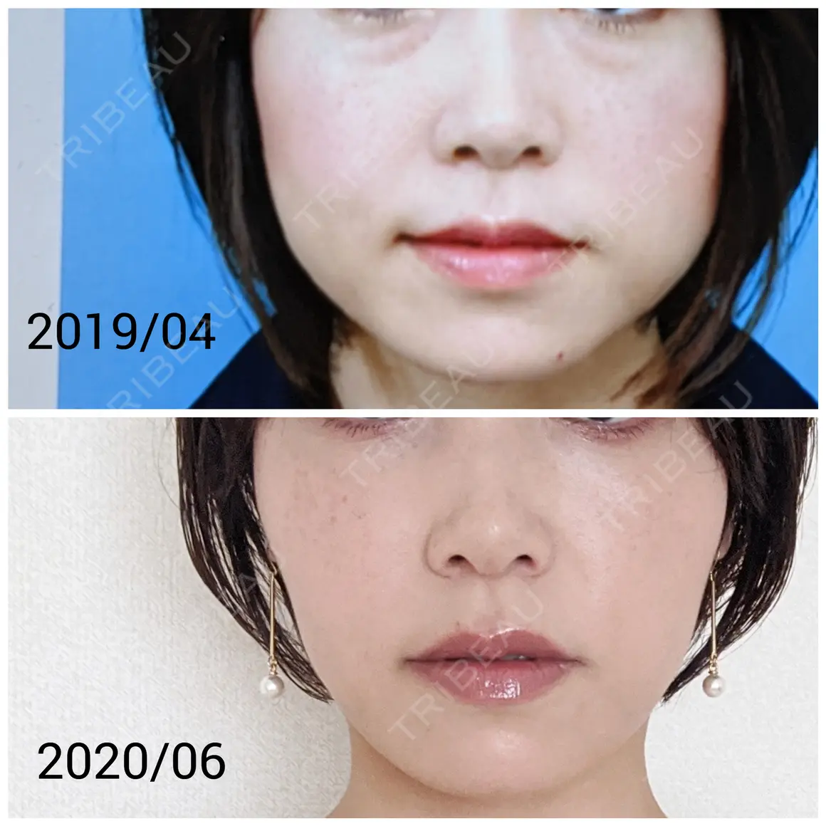 ボトックス（エラ・小顔） 品川美容外科 福岡院 AFTER