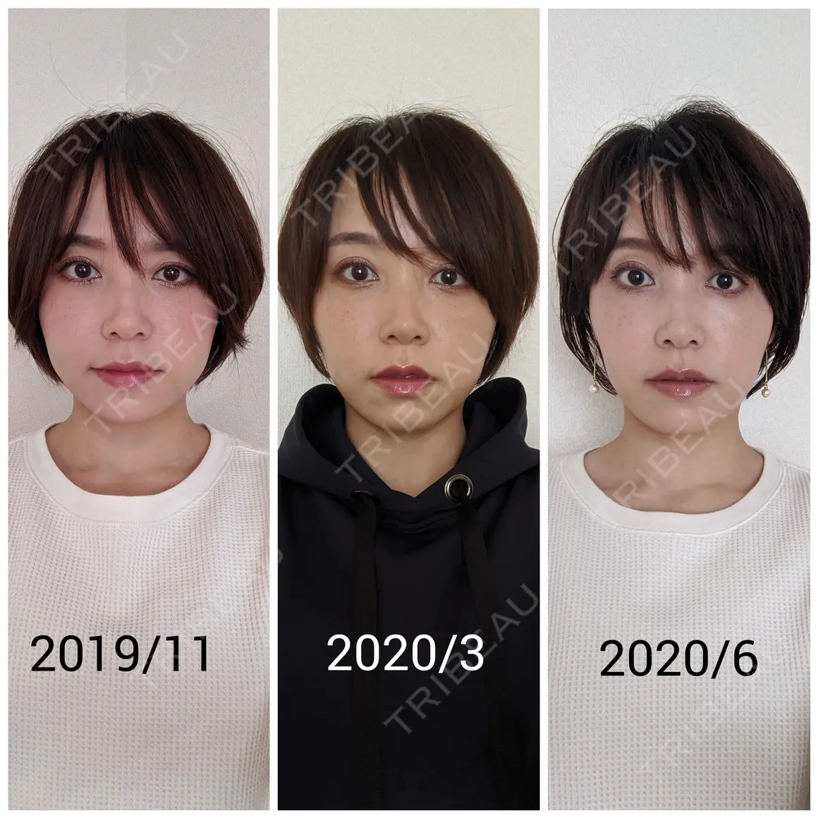 ボトックス（エラ・小顔） 品川美容外科 福岡院 AFTER