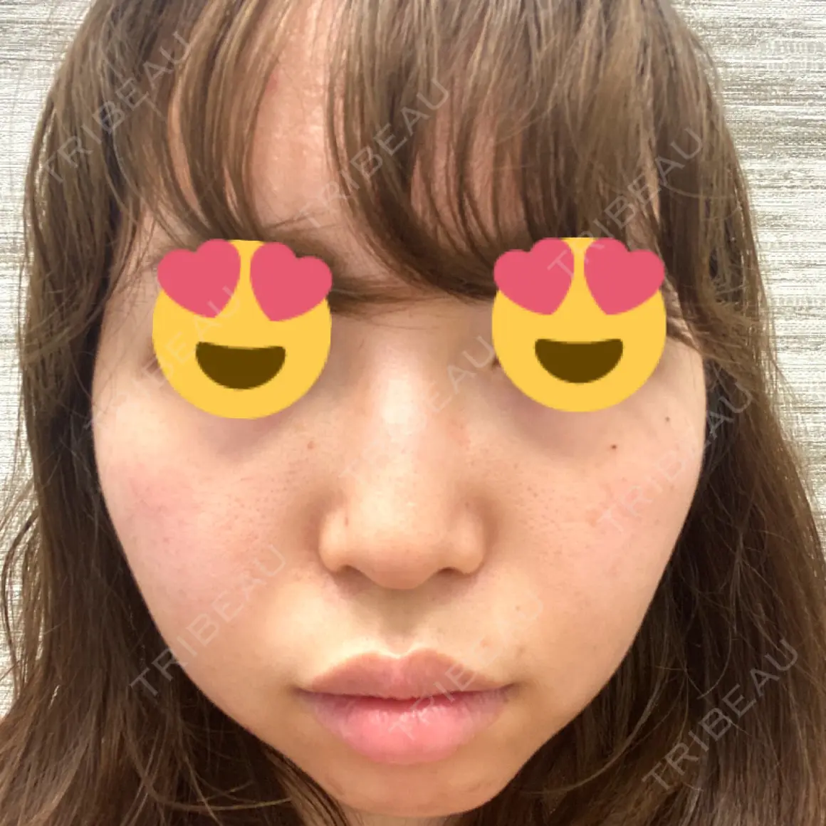 脂肪溶解注射（顔） 品川美容外科 新宿院（※品川スキンクリニック提携） AFTER