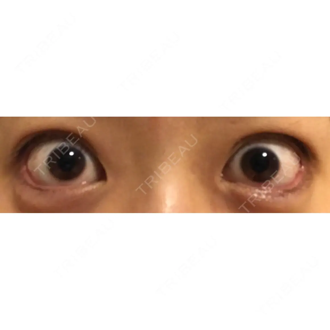 タレ目形成・グラマラスライン（切開） B-LINE CLINIC 池袋院 AFTER