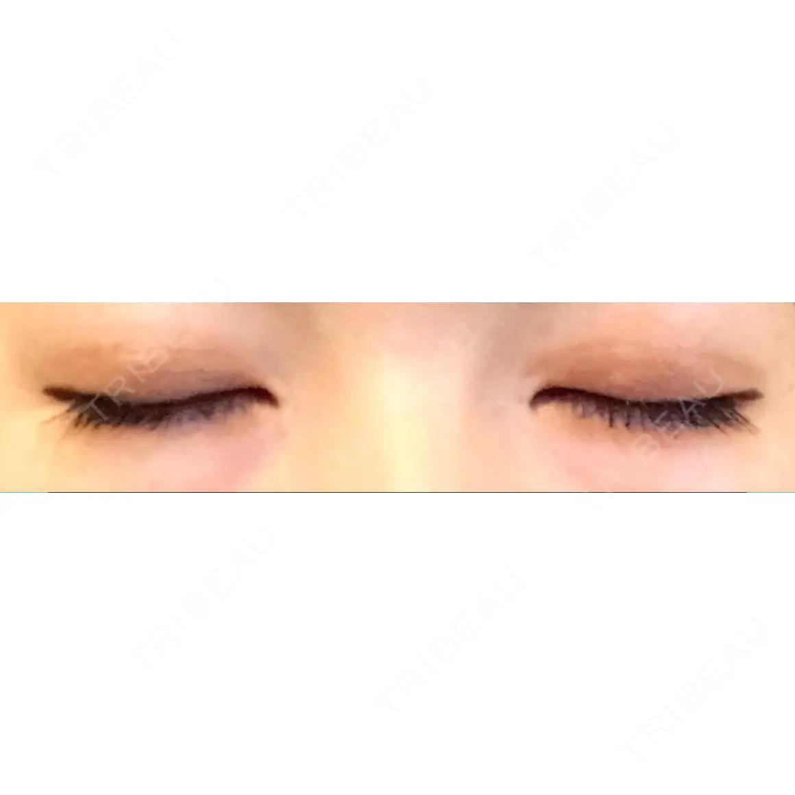 二重埋没 / 目頭切開 / 眼瞼下垂（切開） / 目元修正 / 自然癒着法 POP美容整形クリニック AFTER