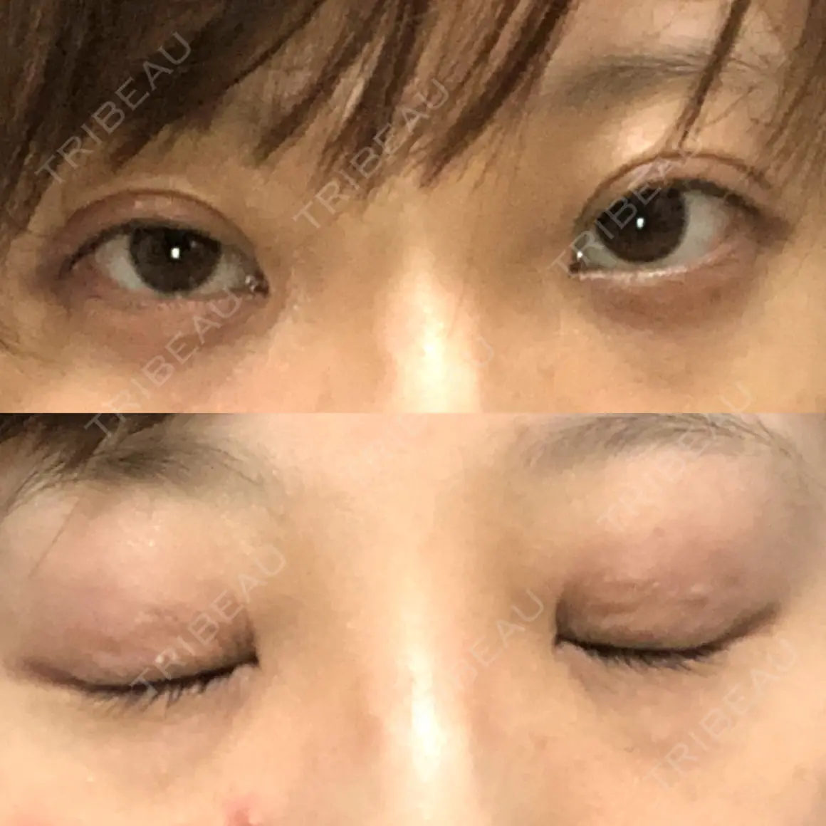 二重埋没 ティーズクリニック AFTER