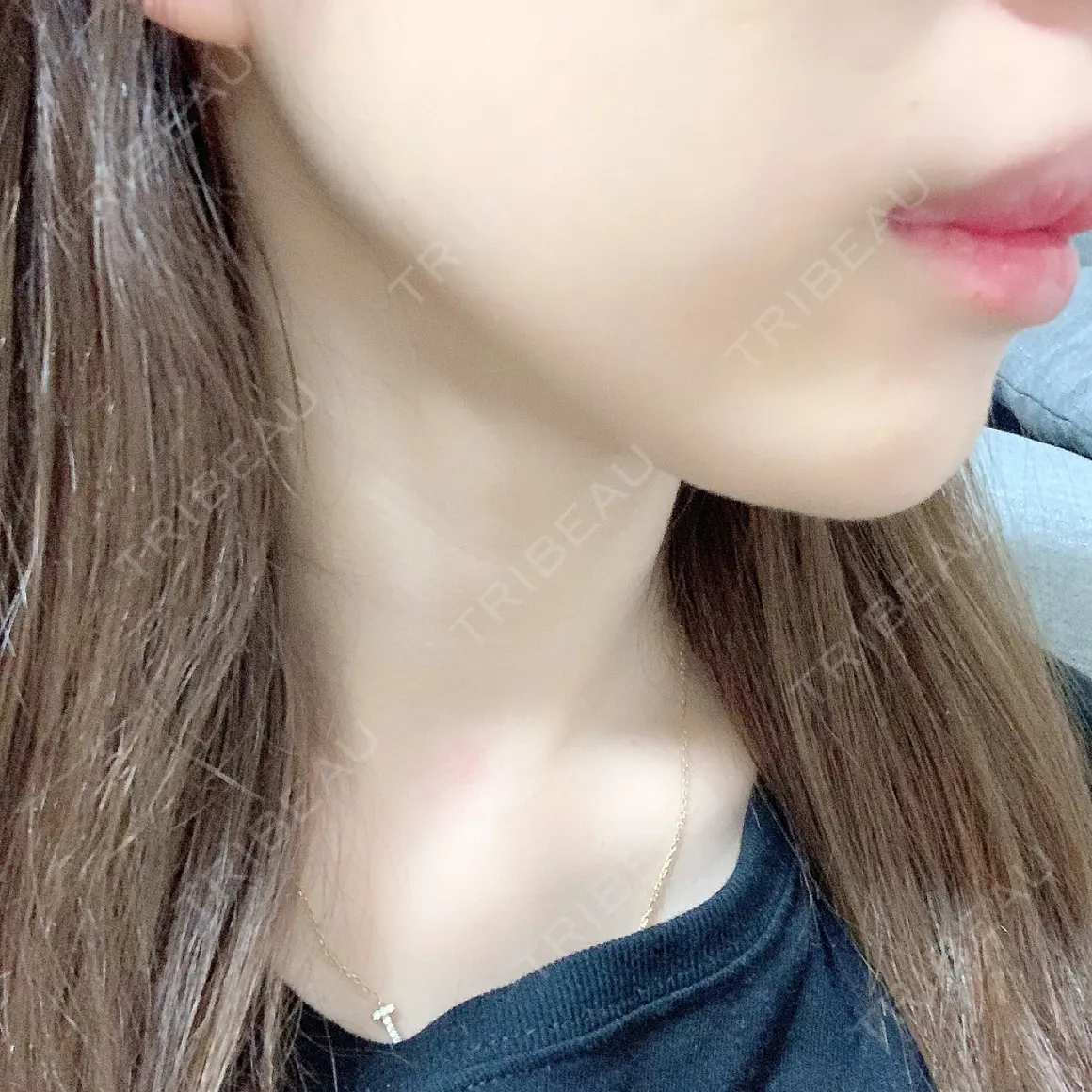 脂肪溶解注射（顔） TCB東京中央美容外科 中野院 AFTER