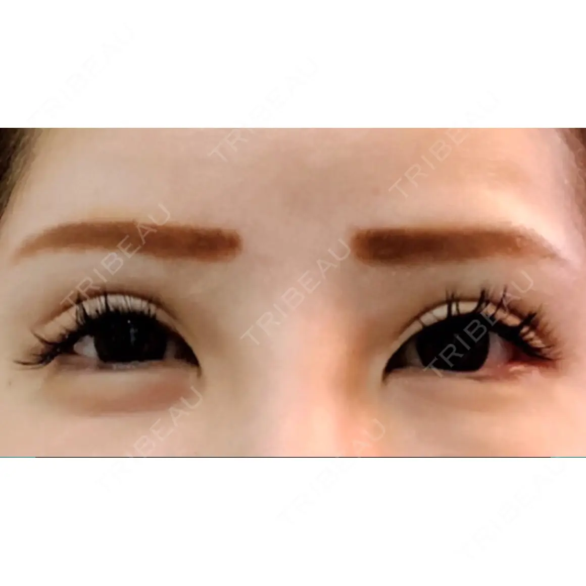 眼瞼下垂（切開） / 糸リフト / 下まぶたの脂肪取り / タレ目形成・グラマラスライン（切開） 大阪TAクリニック DAY 0