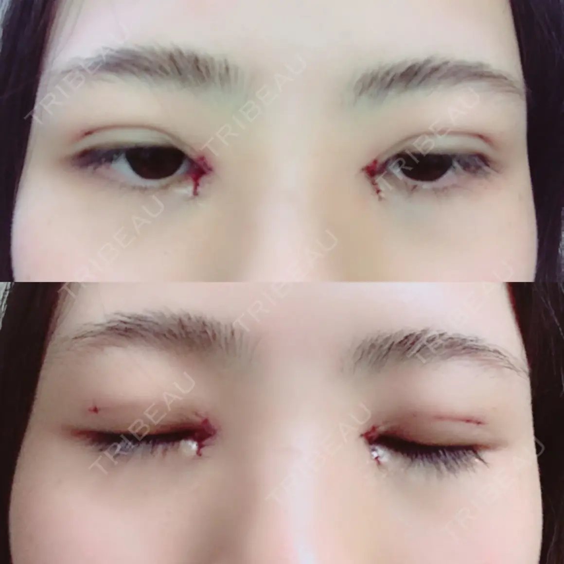 二重埋没 / 目頭切開 / 上まぶたの脂肪取り 湘南美容クリニック 柏院 DAY 0
