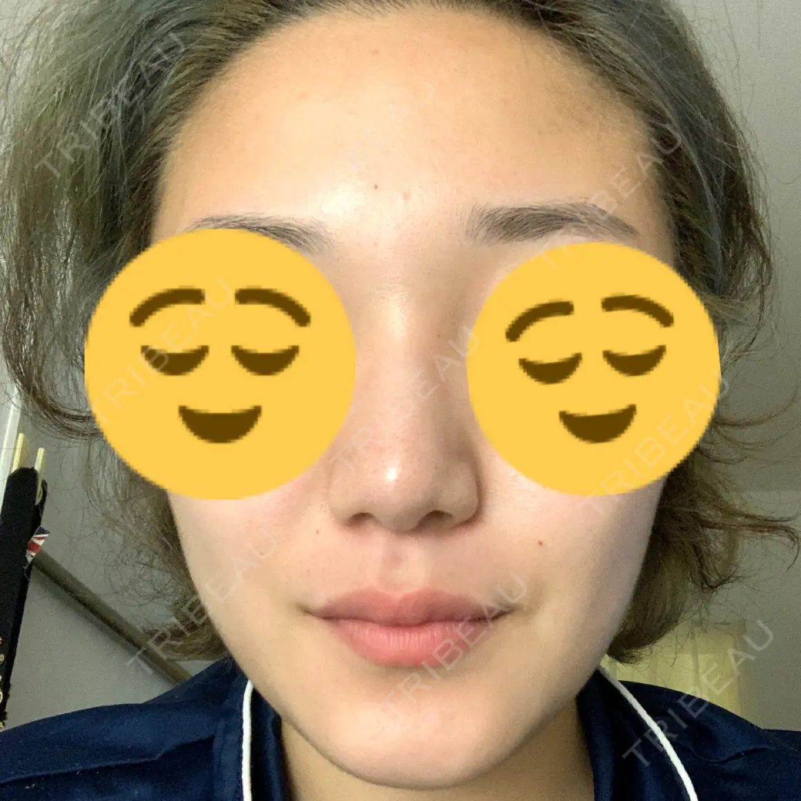 鼻尖形成（切開） / 鼻中隔延長（切開） / 軟骨移植 / ボトックス（あご） / ヒアルロン酸注入（あご） / ボトックス（エラ・小顔） / ボトックス（肩） / その他（鼻） エートップ美容整形外科 AFTER