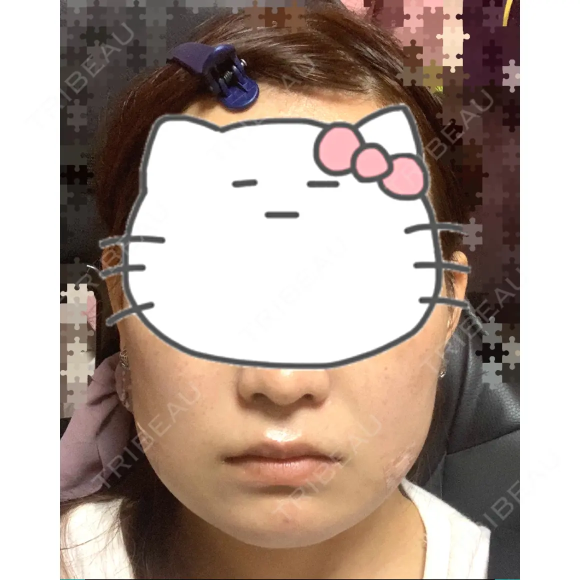 脂肪溶解注射（顔） 東京ロイヤルクリニック DAY 0