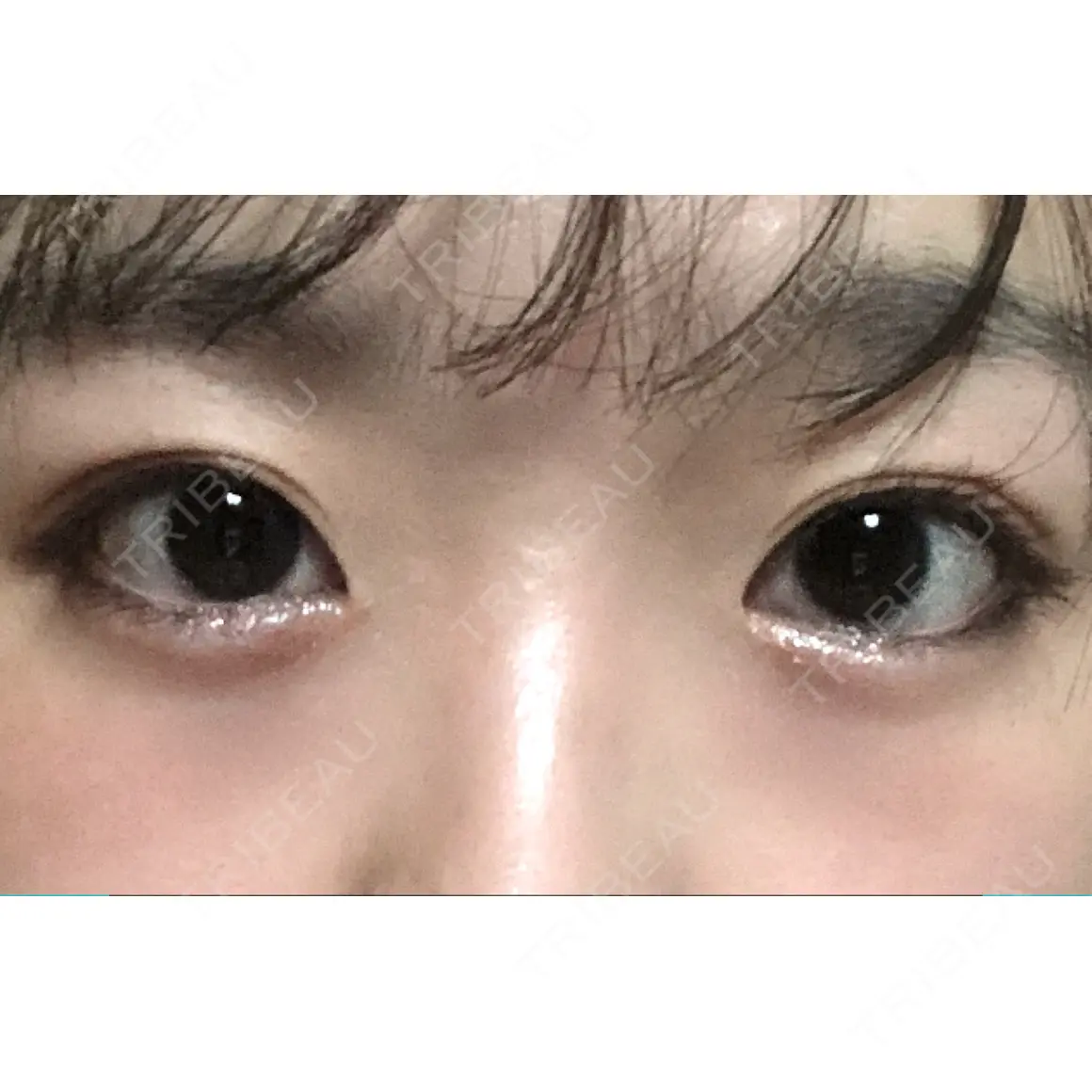 ボトックス（エラ・小顔） / 脂肪溶解注射（顔） / ヒアルロン酸注入（唇） / ボトックス（口角） id美容クリニック 銀座院 AFTER