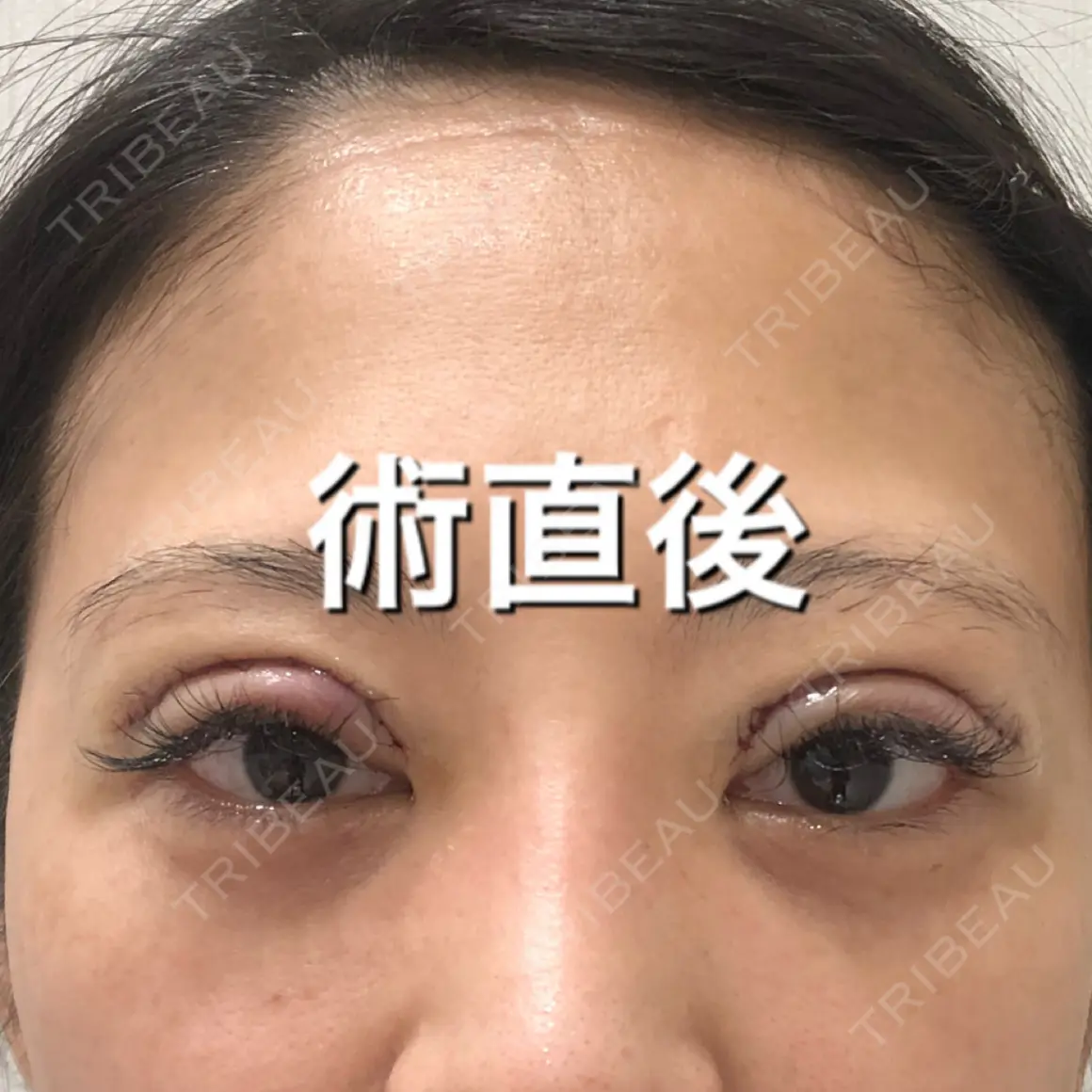 二重切開 / 上まぶたの脂肪取り BIANCA銀座 DAY 0