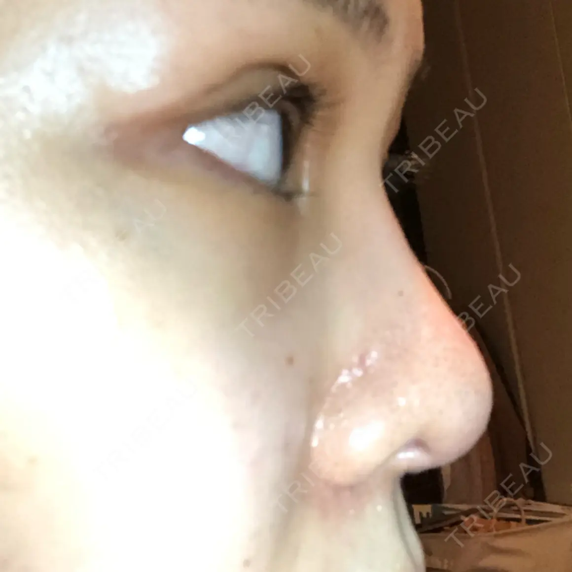 鼻尖形成（切開） / 鼻中隔延長（切開） / 小鼻縮小（切開） / 真皮移植 加美（GAMI）整形外科 AFTER