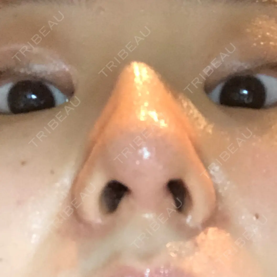 鼻尖形成（切開） / 鼻中隔延長（切開） / 小鼻縮小（切開） / 真皮移植 加美（GAMI）整形外科 AFTER