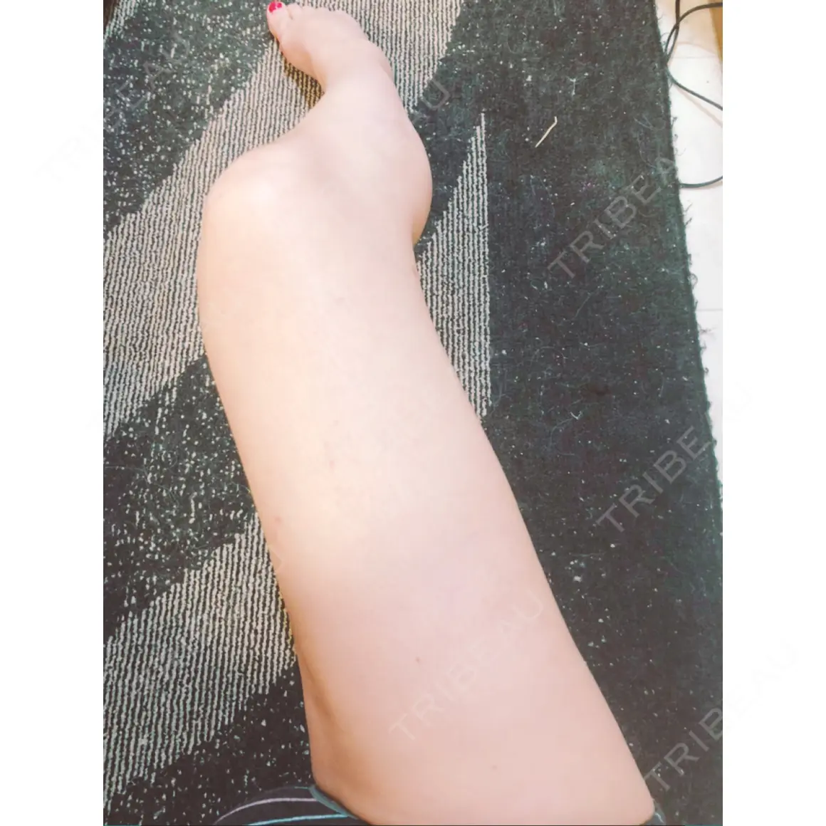 脂肪吸引（脚） REX整形外科 AFTER