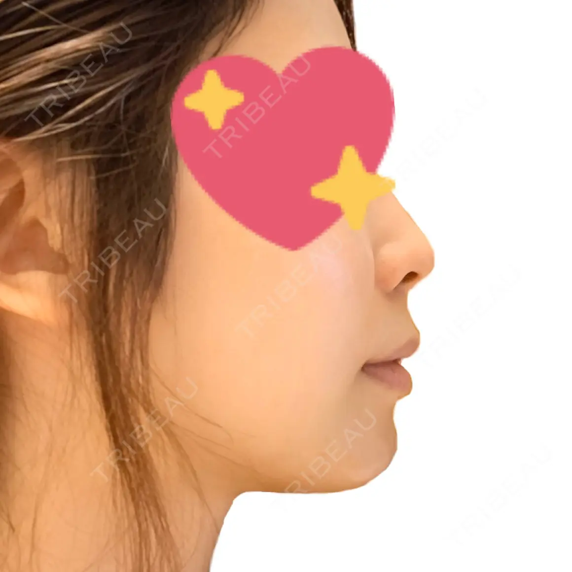 ヒアルロン酸注入（あご） 高須クリニック 大阪院 AFTER