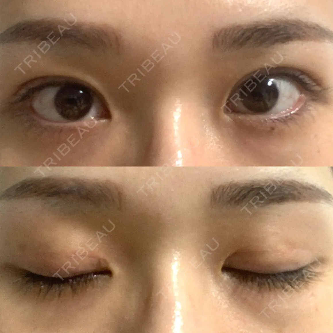 二重切開 蘇春堂形成外科 AFTER