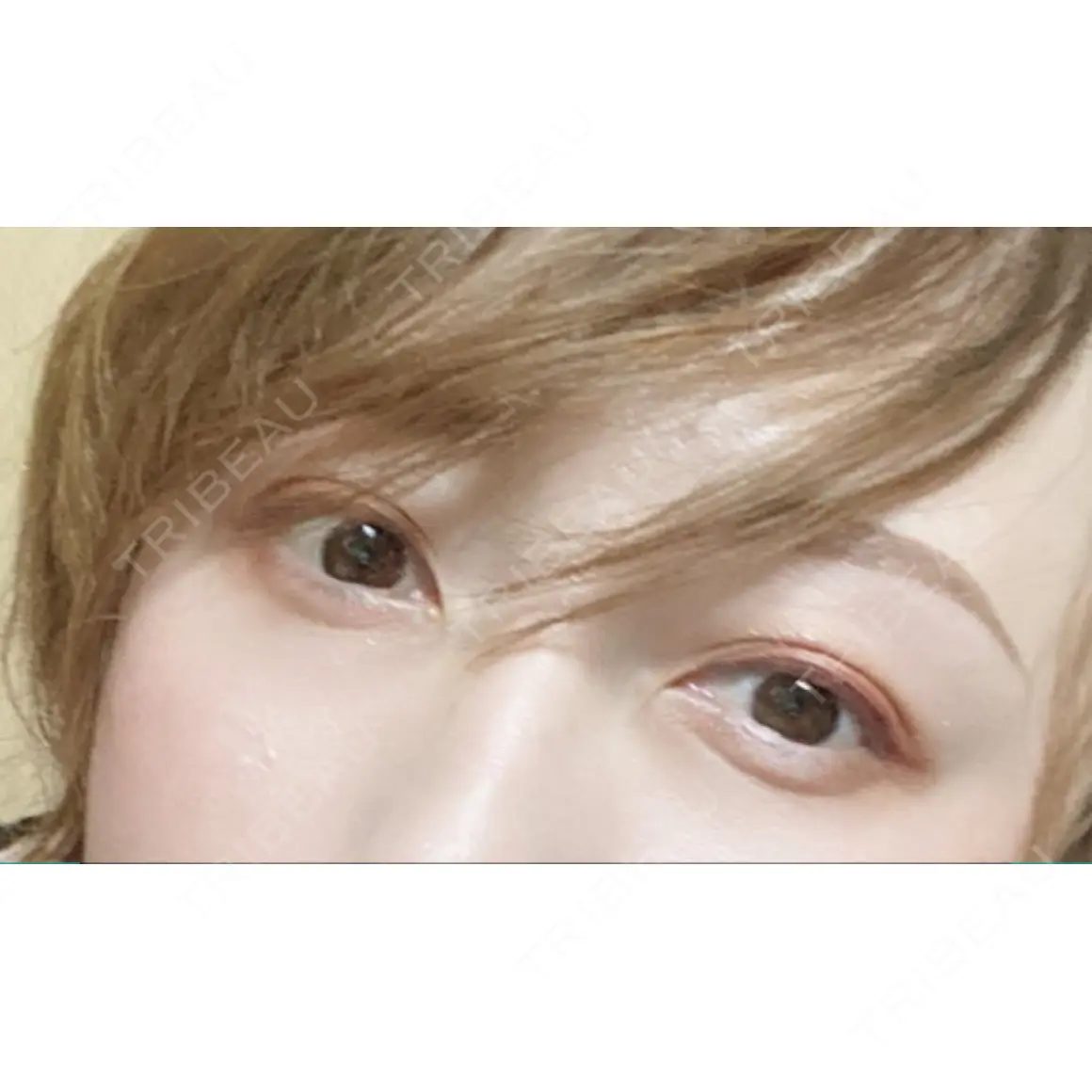 二重埋没 / 目尻切開 id美容クリニック 銀座院 AFTER