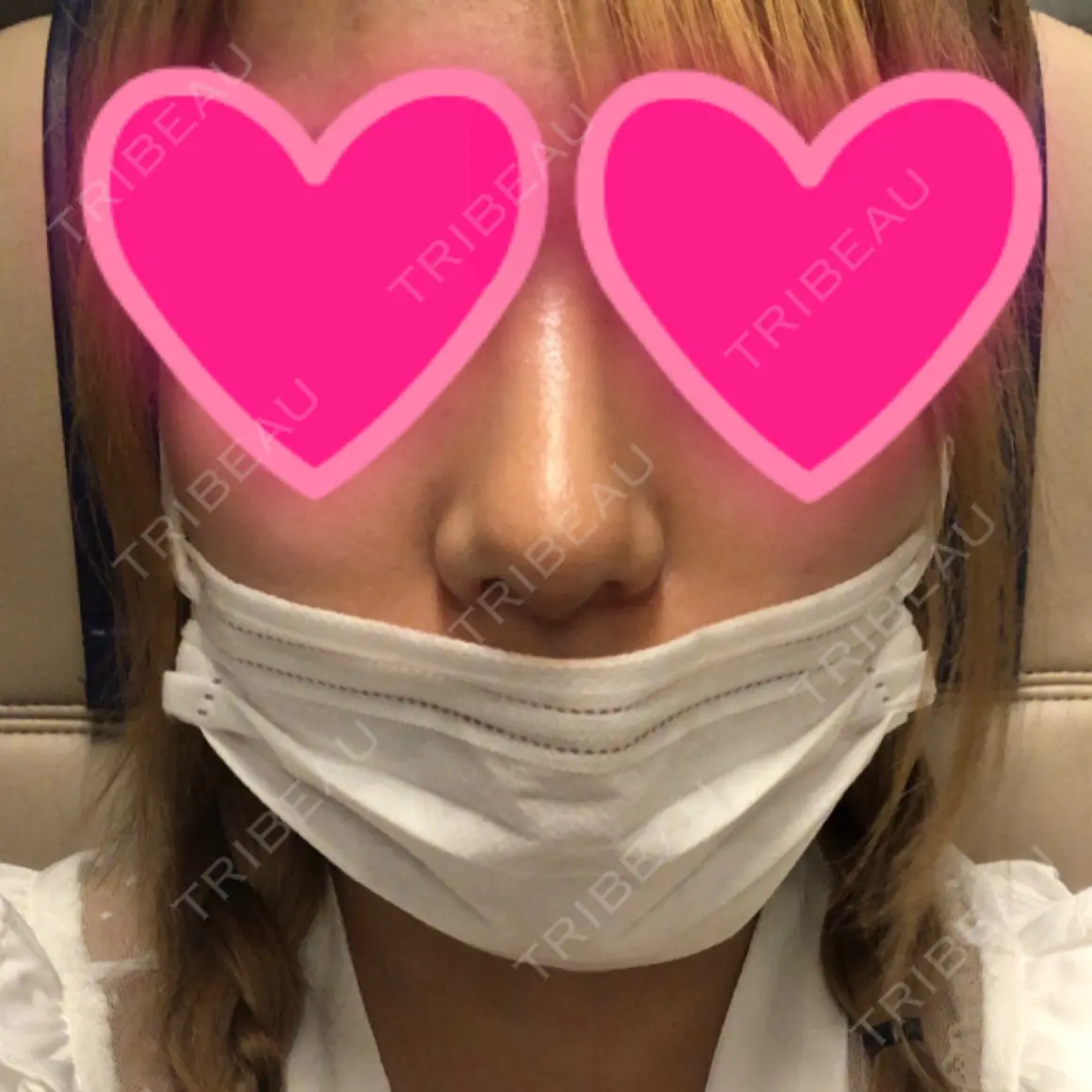 隆鼻術 / 鼻尖形成（切開） / 小鼻縮小（切開） / 骨切幅寄せ ソウルクイーン整形外科（旧コエンミ整形外科） AFTER