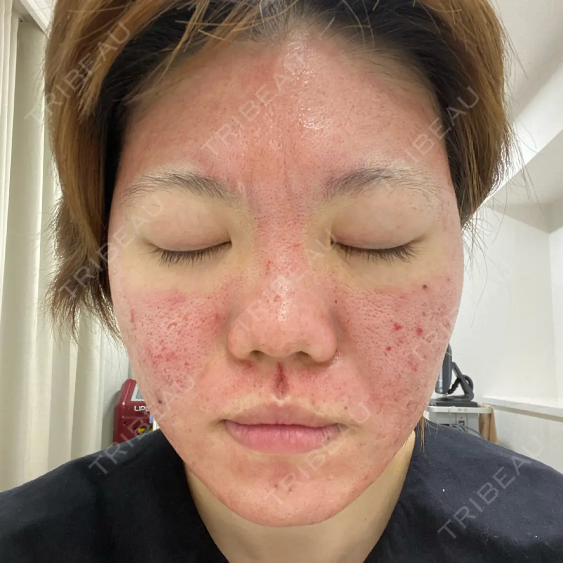 PRP皮膚再生療法 VENUS BEAUTY CLINIC　銀座院 DAY 0