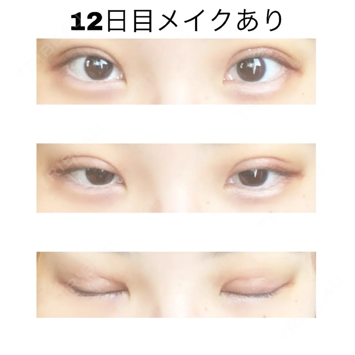 二重埋没 / 上まぶたの脂肪取り 高崎TAクリニック AFTER