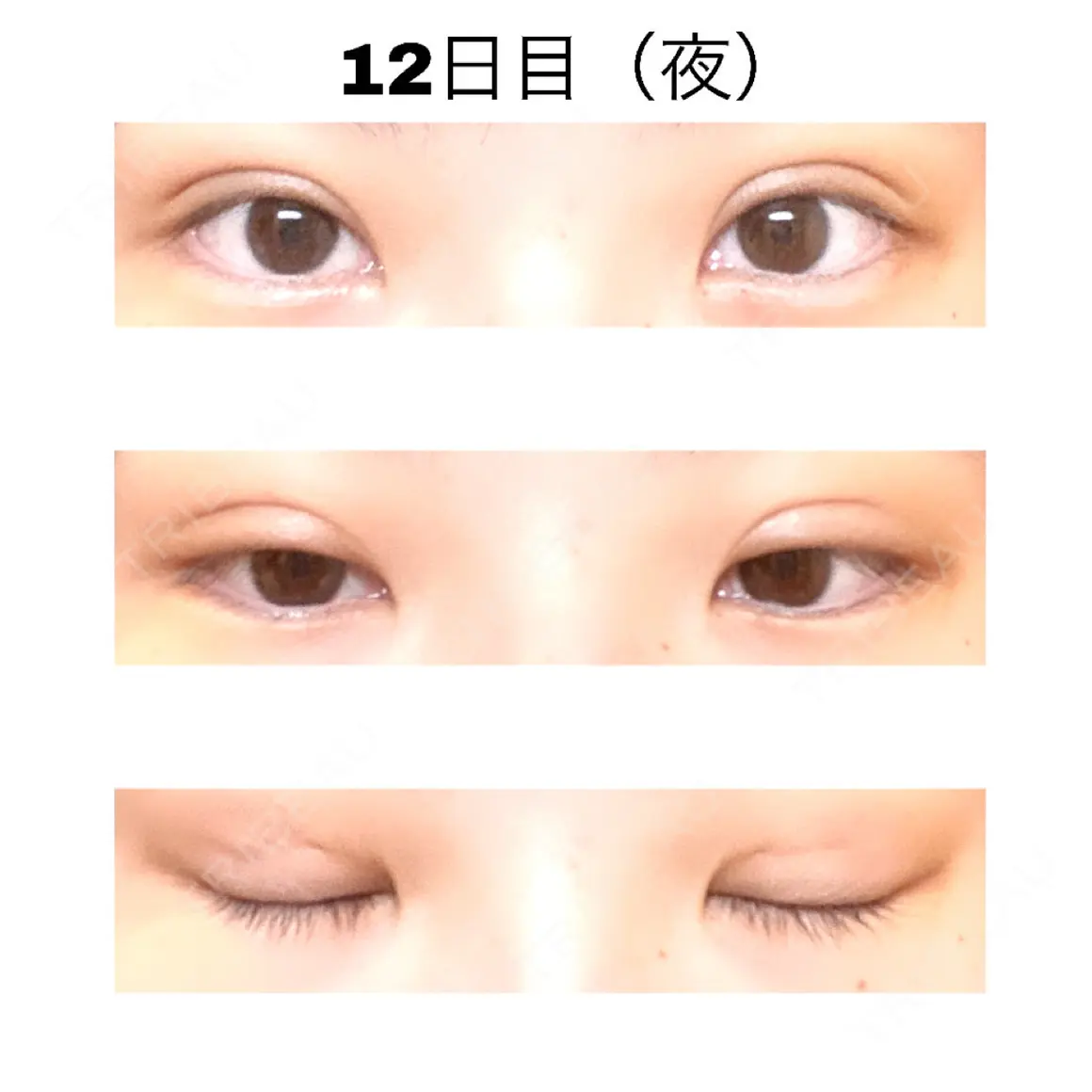 二重埋没 / 上まぶたの脂肪取り 高崎TAクリニック AFTER