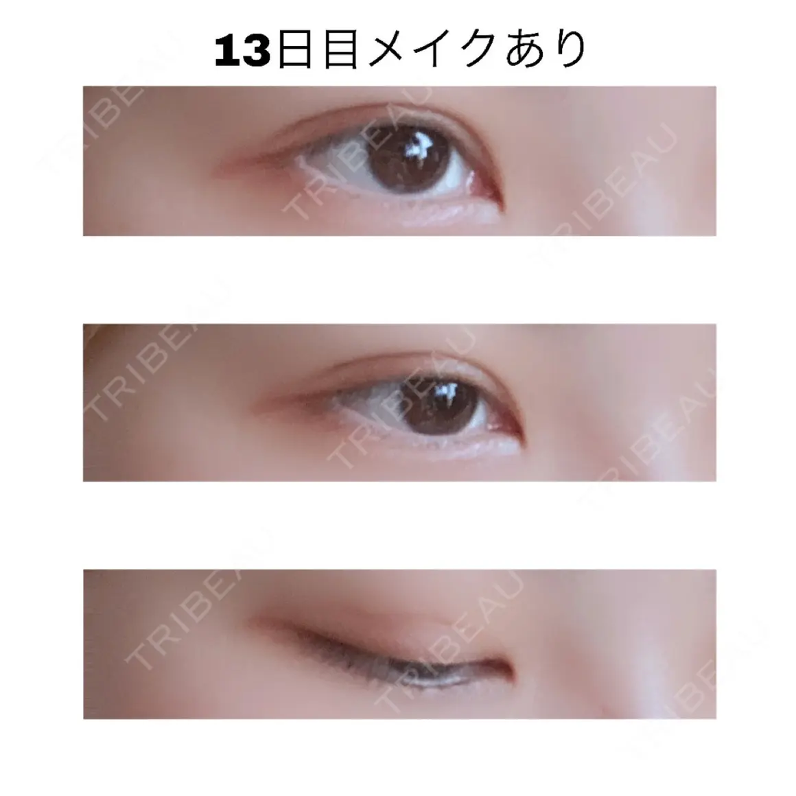 二重埋没 / 上まぶたの脂肪取り 高崎TAクリニック AFTER
